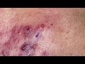 NEW VIDEOS 2026 🔥 RELAXING SKIN CLEANING VIDEO!
