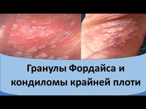 Гранулы фордайса лечение в домашних условиях