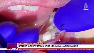 Pendakap Gigi Anak Kecil