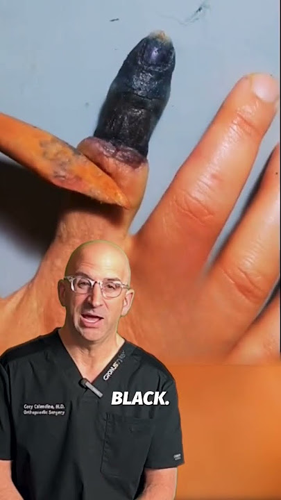 What if Finger Loses Blood Supply?🩸#shorts