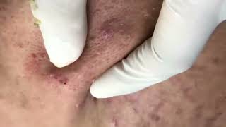 BLACKHEAD EXTRACTION & PIMPLE POPPING | BLACKHEAD REMOVAL