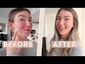 My Acne Makeup Routine // Acne Positivity