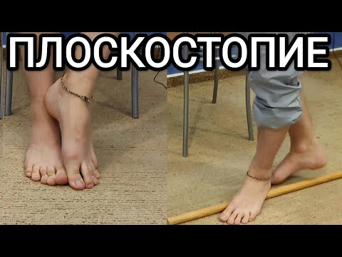 Лечебная физкультура при ПЛОСКОСТОПИИ - Гимнастика на каждый день