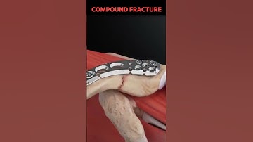 Compound Fracture Joining Video 3d Animated || VEB Tube
