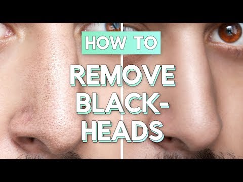 No Bullsh*t Blackhead Removal - How To Remove Blackheads From Face / Nose ✖ James Welsh