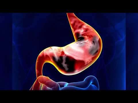 Видео: Рак желудка: причины, симптомы и лечение