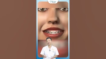 Niềng Răng Điều Trị Khớp Cắn Sâu | Bác Sĩ Yên