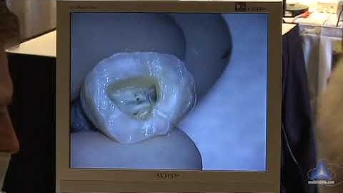 Access Tricks - Negotiating the MB2: Advanced Endodontics