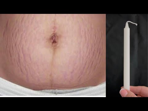 Vídeo: Bepanthen Stretch Mark Cream comentário