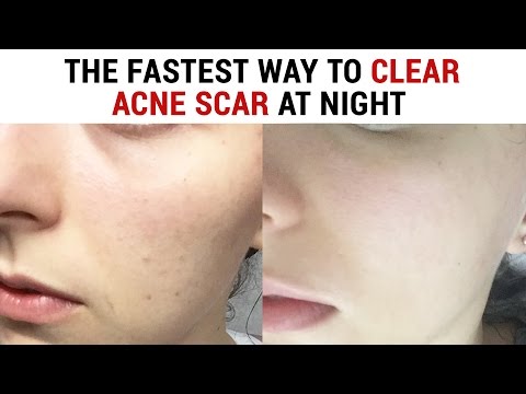 The Most Effective Night Care Routine to Clear Acne Scars | Wishtrend