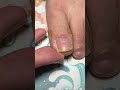Toe Nail Fixer| Ingrown Toenail Cleaning & Care #ToenailFix #NailCare #FootCare #PedicureClean