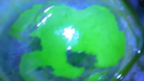 Recurrent Corneal Erosion