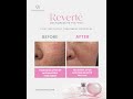 CuraScience | Microneedling Treatment Recovery with Reverte DermaRestore Pro Vial