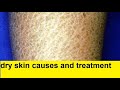 Dry skin causes and treatment