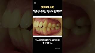 [치아교정] &quot;앞니 각도를 바꾸고 싶어요&quot; 돌출의 교정치료 (전후사진 포함) #신촌치과 #이슈 #신촌교정
