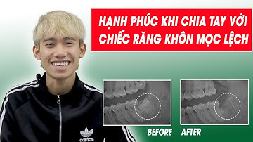 Sức tàn phá của răng khôn mọc lệch nguy hiểm như thế nào ? Bạn cần nhổ sớm hay không?