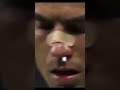 Cristiano ronaldo breaks his nose vs czech republic 