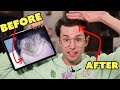 How I Fixed My Balding (One Year After Surgery)