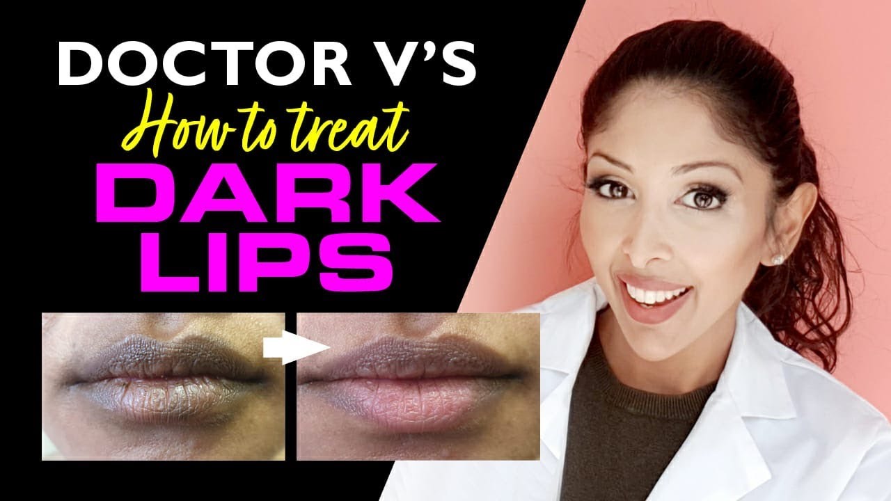 Doctor V- How To Treat Lip Hyperpigmentation/ Dark Lips| Brown/Dark Skin Lip Pigmentation Treatment