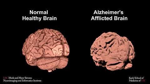 Normal and Alzheimer