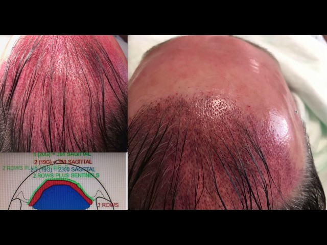 Hair Transplant Megasession for Hairline, Central Forelock, Midscalp in Dallas, TX