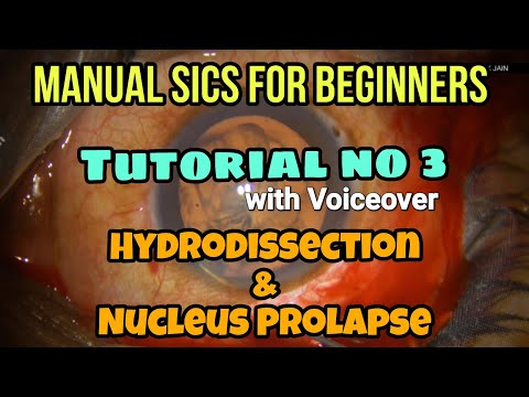 #137 Manual SICS for beginners: basics of Hydrodissection and nucleus prolapse: tutorial no. 3