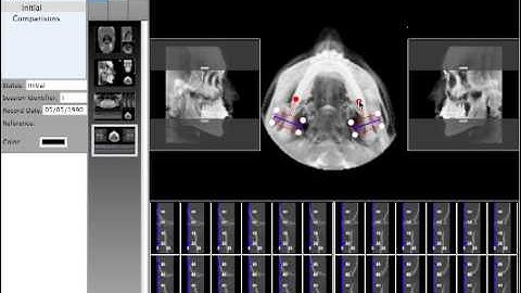 Quick Ceph Studio - Extracing Condyle Views from CT Scan