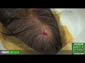 Pilar Cyst - Stubborn Cyst of the Scalp Gets Busted!