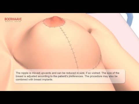 Breast lift Animation - Boerhaave Medical Centre