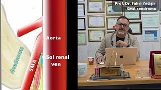 Süperior Mezenterik Arter Sendromu Şematik Anlatımı