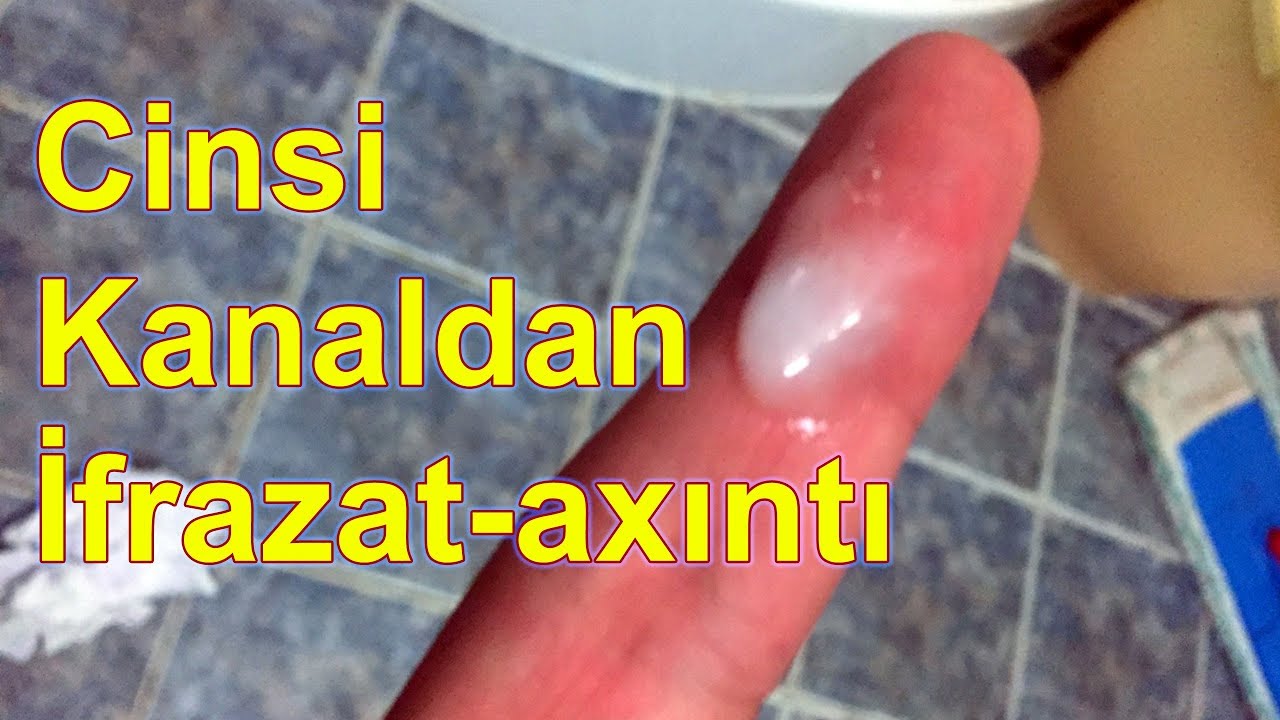 Kişilərdə sidik kanalından ifrazat gəlməsi