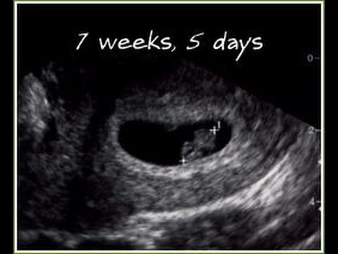 IVF Pregnancy: 7 weeks 5 days Ultrasound Update - YouTube