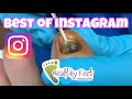 The BEST INGROWN NAILS.  PART 1