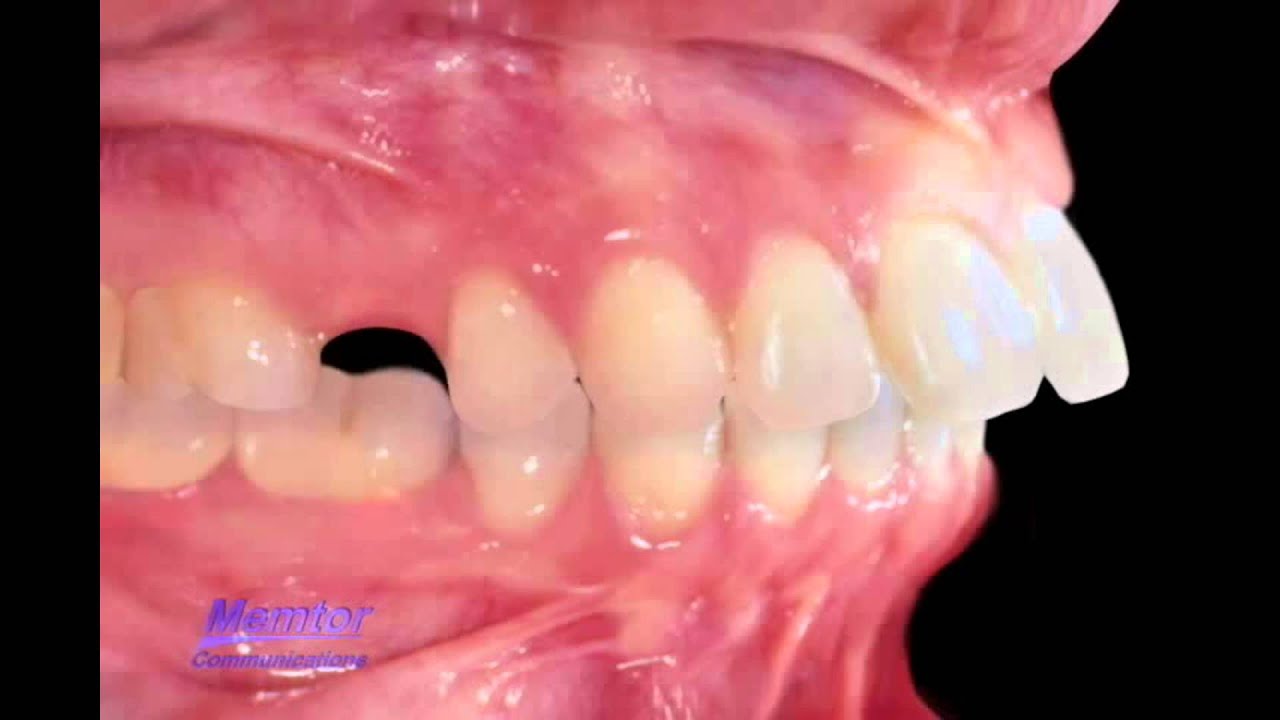 Extraction of teeth to correct overjet-overbite - YouTube