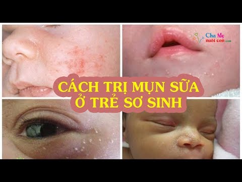 Cách trị mụn sữa ở trẻ sơ sinh