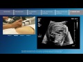 Key screening views of the fetal heart - Part 6 - Vessel view