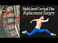 “I Was Temporarily Paralyzed” | Recovering from Neck Surgery with Hypermobility