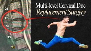 “I Was Temporarily Paralyzed” | Recovering from Neck Surgery with Hypermobility