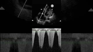 Type 2 Pulmonary Hypertension from Left Heart Failure #ultrasound #pocus #echo #emergencymedicine