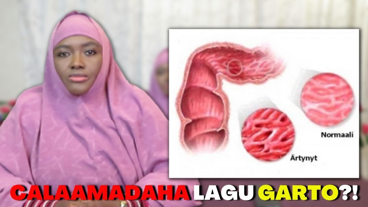 CALAAMADAHA LAGU GARTO BAABASIIRKA, IYO NUUCYADA UU UKALA BAXO! DAAWASHO WACAN!