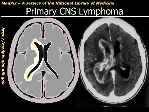 Primary CNS (Brain) Lymphoma