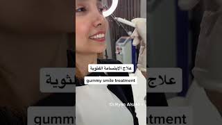 علاج الابتسامة اللثوية gummy smile treatment