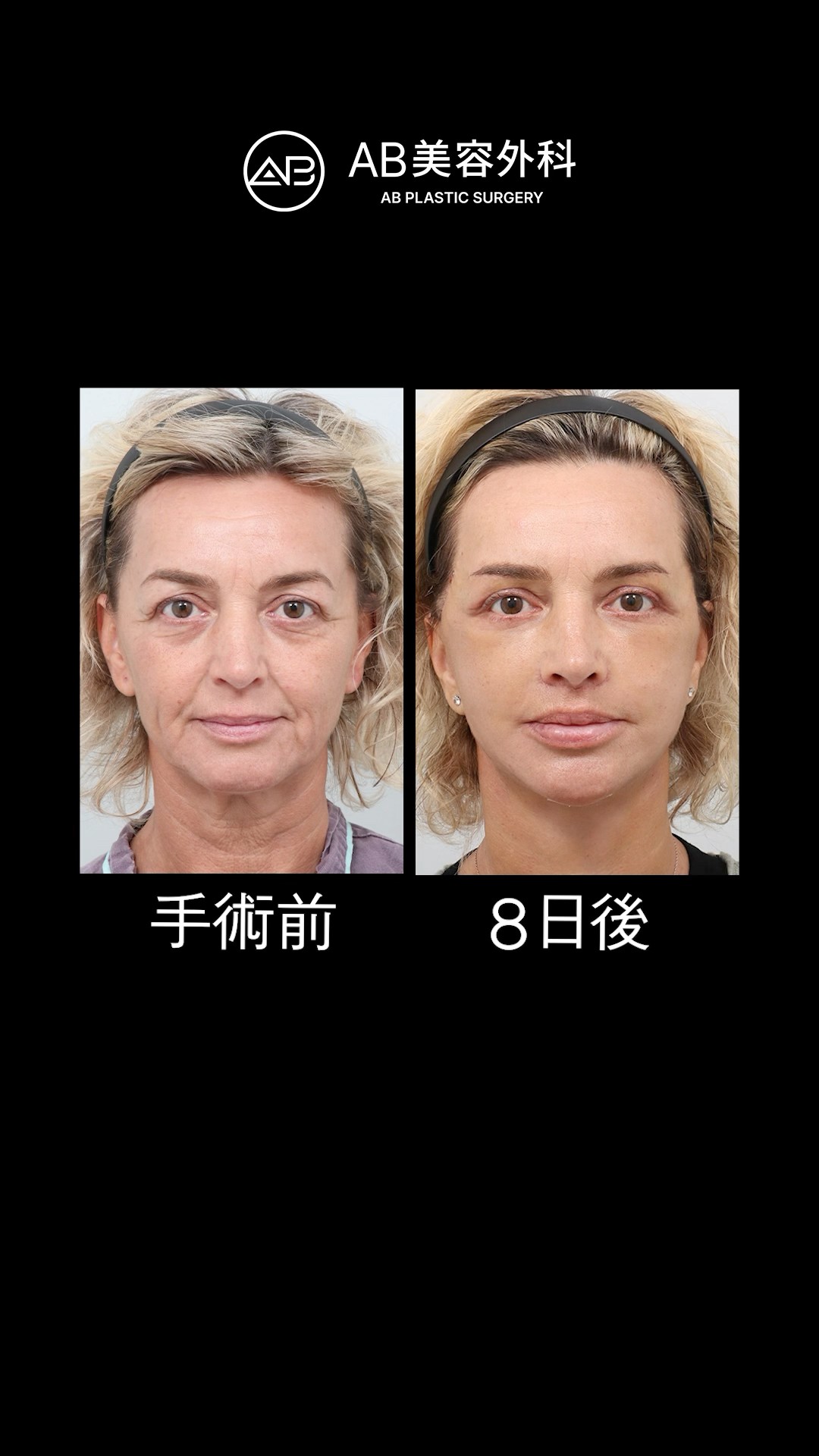 たった8日でこの変化？リフトアップ効果がすごい！ | AB美容整形