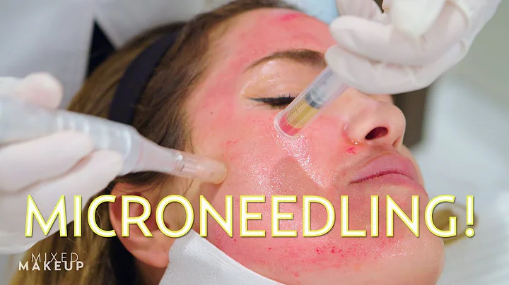 Vampire Facial? We tried Microneedling with PRP! |...