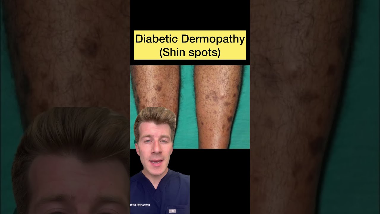 12 Skin Conditions Linked With Diabetes Shorts Dermatology Doctor Health