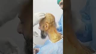 #FUEHairTransplant #haircare #faceoffclinic #khanaesthetics #beauty #sialkot