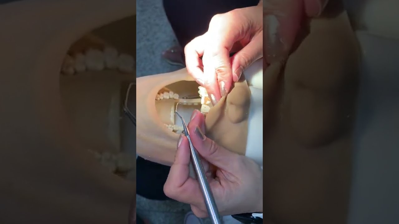 APD #33 PERIODONTIA: COMO UTILIZAR AS CURETAS DURANTE UMA RASPAGEM?