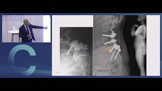 Surgery For High Grade Spondylolisthesis Obeid Eurospine 2025