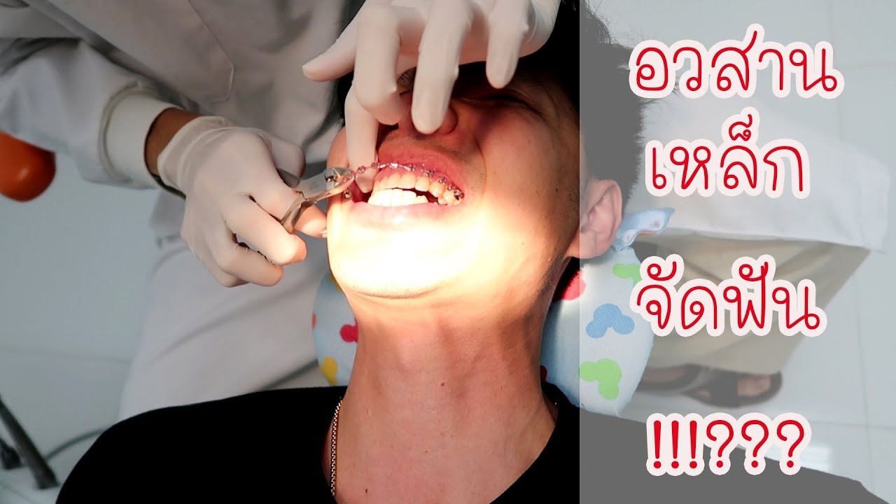 ตอนที่ 9 สิ่งควรรู้ สำหรับการจัดฟัน EP9 : อวสานเหล็กจัดฟัน???!!!