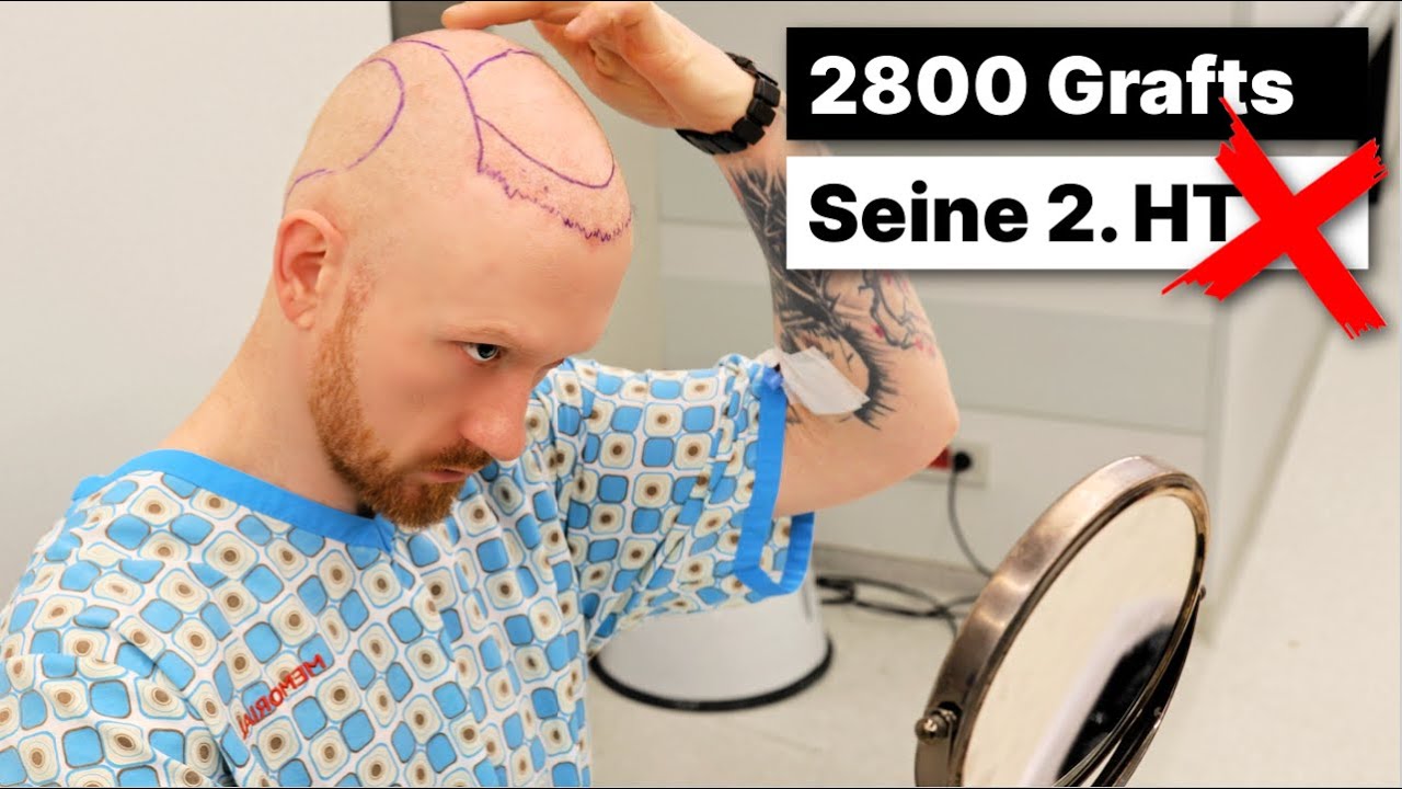 2800 Grafts Haartransplantation.. Peters zweite Erfahrung mit der haar OP | Memorial Istanbul